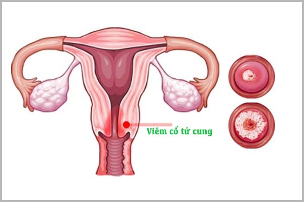 (Giải đáp) Bị viêm cổ tử cung có mang thai được không