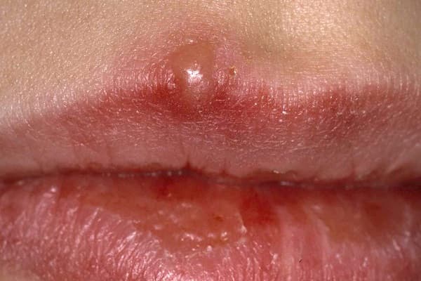 Hình ảnh đáng sợ của bệnh giang mai ở người lớn và trẻ em