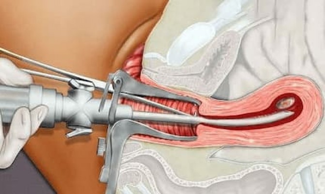 Hút thai có đau không và an toàn không? Quy trình 5 bước an toàn
