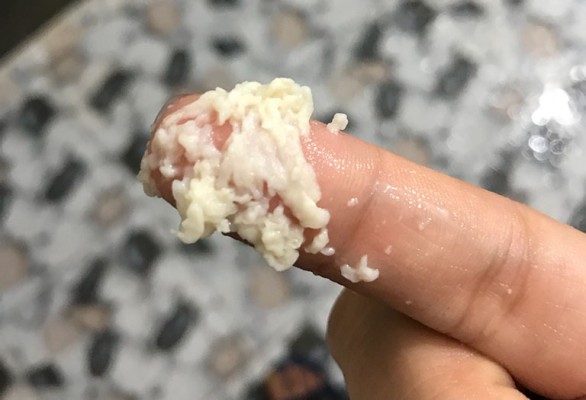 Ra nhiều khí hư màu trắng như bã đậu có nguy hiểm không và nên làm gì