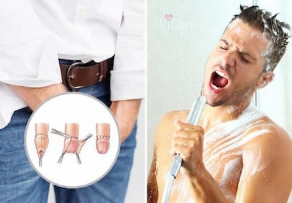 Sau khi cắt bao quy đầu có được tắm không?