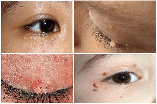 Bệnh sùi mào gà ở mắt: Nguyên nhân, dấu hiệu, cách chữa, phòng tránh