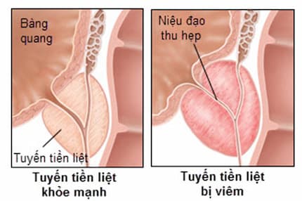 Bệnh về tuyến tiền liệt