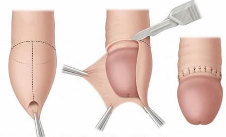 Sau khi cắt bao quy đầu cần lưu ý gì