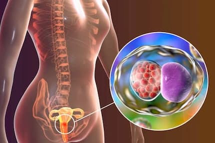 Dấu hiệu viêm cổ tử cung