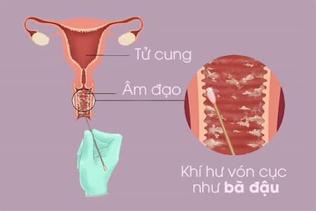 Hiện tượng khí hư màu trắng như bã đậu