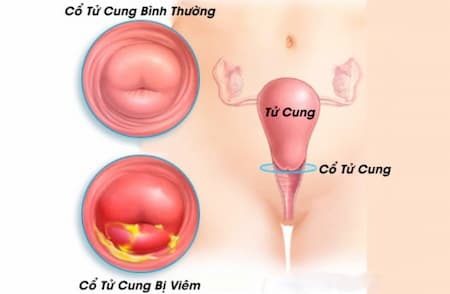 Khí hư màu trắng như bã đậu là gì