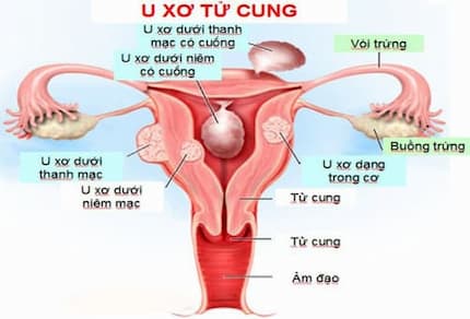 u xơ tử cung